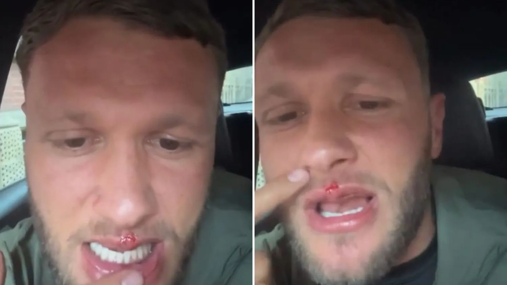‘Hardest man in UK’ Big Stacks pokazuje rozciętą wargę i krzywe zęby po uderzeniu rywala z Misfits Boxing